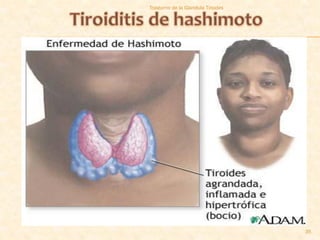 Trastorno de la Glandula Tiroides




                                    35
 