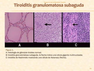Trastorno de la Glandula Tiroides




Figura 1.
A: histología de glándula tiroides normal;
B: tiroiditis granulomatosa subaguda, la flecha indica una célula gigante multinucleada;
C: tiroiditis de Hashimoto mostrando una célula de Askanazy (flecha).




                                                                                           39
 