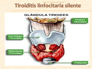 Trastorno de la Glandula Tiroides




                                    42
 
