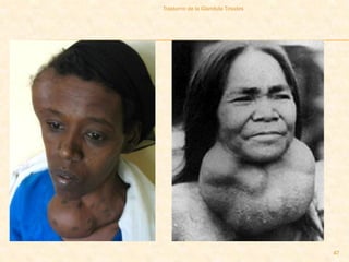 Trastorno de la Glandula Tiroides




                                    47
 