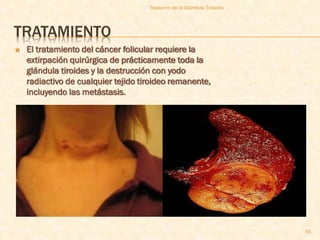 Trastorno de la Glandula Tiroides




TRATAMIENTO
   El tratamiento del cáncer folicular requiere la
    extirpación quirúrgica de prácticamente toda la
    glándula tiroides y la destrucción con yodo
    radiactivo de cualquier tejido tiroideo remanente,
    incluyendo las metástasis.




                                                                         51
 