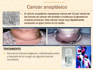 Trastorno de la Glandula Tiroides




                   El cáncer anaplásico representa menos del 10 por ciento de
                    las formas de cáncer del tiroides e incide por lo general en
                    mujeres ancianas. Este cáncer crece muy rápidamente
                    causando un gran tumor en el cuello.




TRATAMIENTO
   Fármacos anticancerígenos y radioterapia antes
    y después de la cirugía da algunos buenos
    resultados.

                                                                               52
 