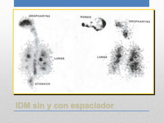 IDM sin y con espaciador
 