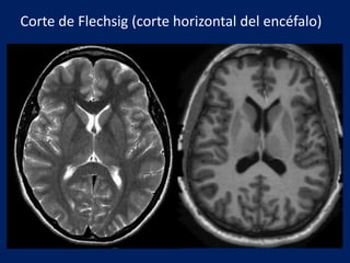 Corte de Flechsig (corte horizontal del encéfalo)
 