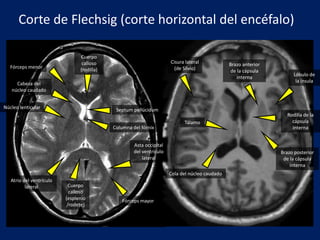 Fórceps menor
Fórceps mayor
Cuerpo
calloso
(esplenio
/rodete)
Cuerpo
calloso
(rodilla)
Tálamo
Núcleo lenticular
Cabeza del
núcleo caudado
Cisura lateral
(de Silvio)
Cola del núcleo caudado
Lóbulo de
la ínsula
Rodilla de la
cápsula
interna
Brazo anterior
de la cápsula
interna
Brazo posterior
de la cápsula
interna
Corte de Flechsig (corte horizontal del encéfalo)
Columna del fórnix
Septum pellúcidum
Asta occipital
del ventrículo
lateral
Atrio del ventrículo
lateral
 