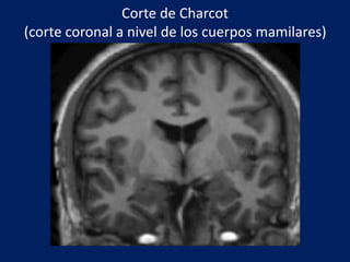 Corte de Charcot
(corte coronal a nivel de los cuerpos mamilares)
 