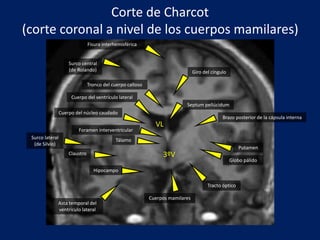 Cuerpo del núcleo caudado
Tálamo
Fisura interhemisférica
Cuerpos mamilares
Claustro
Asta temporal del
ventriculo lateral
Septum pellúcidum
Tracto óptico
Surco lateral
(de Silvio)
Surco central
(de Rolando)
Hipocampo
Corte de Charcot
(corte coronal a nivel de los cuerpos mamilares)
Tronco del cuerpo calloso
Giro del cíngulo
Brazo posterior de la cápsula interna
Cuerpo del ventrículo lateral
Putamen
Globo pálido
Foramen interventricular
VL
3ºV
 