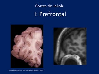 Cortes de Jakob
I: Prefrontal
Tomado de: Forlizzi. Pró: Cortes de Cerebro (2005)
 