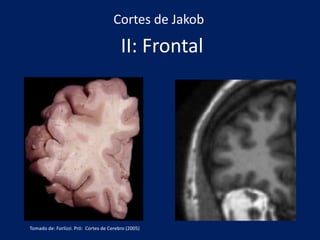 II: Frontal
Cortes de Jakob
Tomado de: Forlizzi. Pró: Cortes de Cerebro (2005)
 