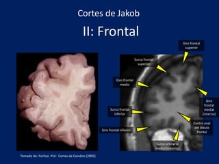 II: Frontal
Giro frontal
superior
Surco frontal
superior
Giro frontal
medio
Surco frontal
inferior
Giro frontal inferior
Giro
frontal
medial
(interno)
Surco orbitario
medial (interno)
Centro oval
del lóbulo
frontal
Cortes de Jakob
Tomado de: Forlizzi. Pró: Cortes de Cerebro (2005)
 