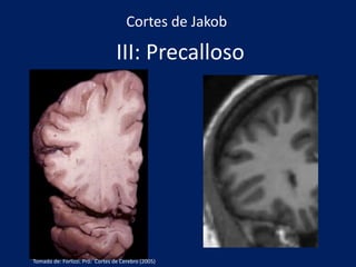 III: Precalloso
Cortes de Jakob
Tomado de: Forlizzi. Pró: Cortes de Cerebro (2005)
 