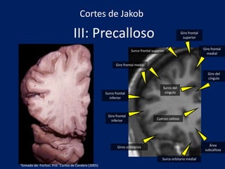 III: Precalloso
Área
subcallosa
Surco orbitario medial
Giros orbitarios
Giro frontal
inferior
Surco frontal
inferior
Giro frontal medio
Surco frontal superior
Giro frontal
superior
Giro frontal
medial
Surco del
cíngulo
Giro del
cíngulo
Cuerpo calloso
Cortes de Jakob
Tomado de: Forlizzi. Pró: Cortes de Cerebro (2005)
 