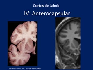 IV: Anterocapsular
Cortes de Jakob
Tomado de: Forlizzi. Pró: Cortes de Cerebro (2005)
 