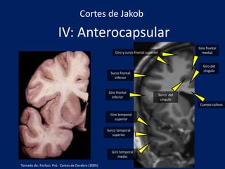 IV: Anterocapsular
Giro y surco frontal superior
Cuerpo calloso
Surco del
cíngulo
Giro frontal
medial
Giro temporal
medio
Giro del
cíngulo
Giro frontal
inferior
Surco temporal
superior
Giro temporal
superior
Surco frontal
inferior
Cortes de Jakob
Tomado de: Forlizzi. Pró: Cortes de Cerebro (2005)
 