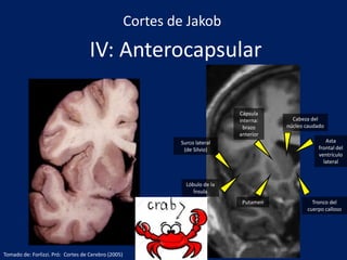 IV: Anterocapsular
Tronco del
cuerpo calloso
Putamen
Lóbulo de la
Ínsula
Cabeza del
núcleo caudado
Cápsula
interna:
brazo
anterior
Surco lateral
(de Silvio)
Cortes de Jakob
Asta
frontal del
ventrículo
lateral
Tomado de: Forlizzi. Pró: Cortes de Cerebro (2005)
 