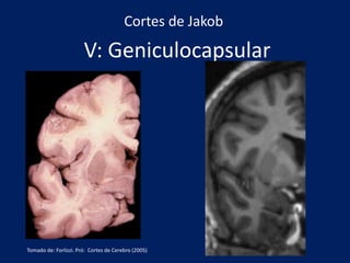 V: Geniculocapsular
Cortes de Jakob
Tomado de: Forlizzi. Pró: Cortes de Cerebro (2005)
 