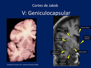 V: Geniculocapsular
Comisura
anterior
Cápsula interna:
rodilla
Cuerpo calloso
Globo pálido
Complejo
nuclear
amigdalino
Claustro
(antemuro)
Putamen
Cortes de Jakob
Tomado de: Forlizzi. Pró: Cortes de Cerebro (2005)
 