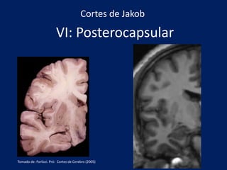 VI: Posterocapsular
Cortes de Jakob
Tomado de: Forlizzi. Pró: Cortes de Cerebro (2005)
 