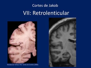 VII: Retrolenticular
Cortes de Jakob
Tomado de: Forlizzi. Pró: Cortes de Cerebro (2005)
 