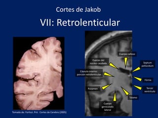 VII: Retrolenticular
Tálamo
Cuerpo
geniculado
lateral
Cápsula interna :
porción retrolenticular
Cuerpo del
núcleo caudado
Cuerpo calloso
Putamen
Fórnix
Septum
pellúcidum
Cortes de Jakob
Tercer
ventrículo
Tomado de: Forlizzi. Pró: Cortes de Cerebro (2005)
 