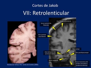 VII: Retrolenticular
Fisura transversa del
cerebro (hendidura
cerebral de Bichat)
Surco central (de
Rolando)
Giro parietal
ascendente
Giro frontal ascendente
Asta temporal del
ventrículo lateral
Cortes de Jakob
Hipocampo
Surco colateral
Giro parahipocampal
Tomado de: Forlizzi. Pró: Cortes de Cerebro (2005)
 
