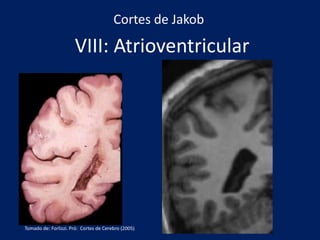VIII: Atrioventricular
Cortes de Jakob
Tomado de: Forlizzi. Pró: Cortes de Cerebro (2005)
 