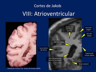 VIII: Atrioventricular
Surco lateral
(de Silvio)
Esplenio del
cuerpo calloso
Surco colateral
Centro oval
del lóbulo
parietal
Cola del núcleo
caudado
Atrio del ventrículo
lateral (encrucijada)
Cortes de Jakob
Giro del
cíngulo
Surco del
cíngulo
Tomado de: Forlizzi. Pró: Cortes de Cerebro (2005)
 