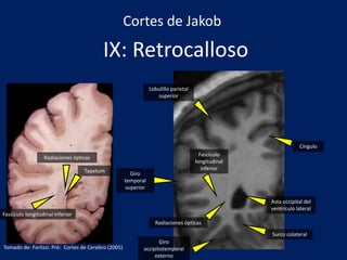 IX: Retrocalloso
Lobulillo parietal
superior
Cíngulo
Surco colateral
Giro
temporal
superior
Fascículo
longitudinal
inferior
Radiaciones ópticas
Giro
occipitotemporal
externo
Asta occipital del
ventrículo lateral
Tapetum
Radiaciones ópticas
Fascículo longitudinal inferior
Cortes de Jakob
Tomado de: Forlizzi. Pró: Cortes de Cerebro (2005)
 