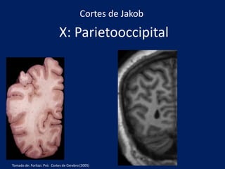 X: Parietooccipital
Cortes de Jakob
Tomado de: Forlizzi. Pró: Cortes de Cerebro (2005)
 