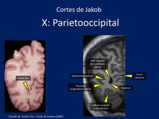 X: Parietooccipital
Lóbulo occipital
(cara inferior)
Radiaciones ópticas
Fascículo
longitudinal inferior
Asta occipital
del ventrículo
lateral
Surco
calcarino
Tapetum
Calcar avis
Cortes de Jakob
Tomado de: Forlizzi. Pró: Cortes de Cerebro (2005)
 