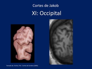 XI: Occipital
Cortes de Jakob
Tomado de: Forlizzi. Pró: Cortes de Cerebro (2005)
 