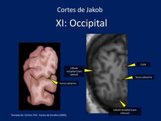 XI: Occipital
Surco calcarino
Lóbulo occipital (cara
inferior)
Cuña
Lóbulo
occipital (cara
lateral)
Surco calcarino
Cortes de Jakob
Tomado de: Forlizzi. Pró: Cortes de Cerebro (2005)
 