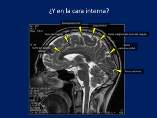 Surco paracentral
Surco central
Rama marginal del surco del cíngulo
Surco
parietooccipital
Surco calcarino
Surco del cíngulo
Surco del cuerpo
calloso
¿Y en la cara interna?
 