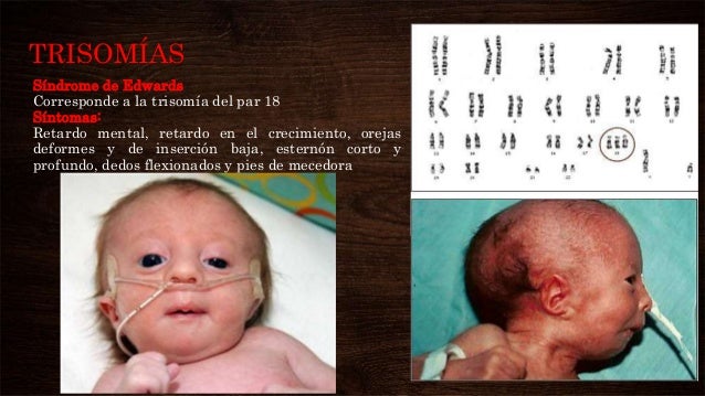 El Sindrome De Down Es Una Monosomia Y