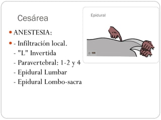 Cesárea
 ANESTESIA:
 - Infiltración local.
- "L" Invertida
- Paravertebral: 1-2 y 4
- Epidural Lumbar
- Epidural Lombo-sacra
 