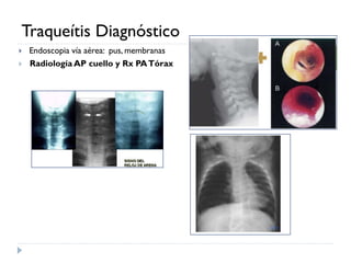 Traqueitis Rx Comprehensive Pediatric Airway Disease Management: Diagnosis and ...