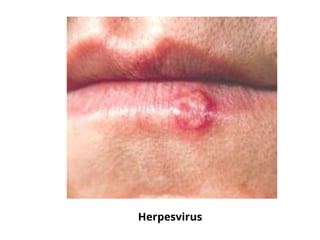 Herpesvirus
 