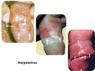 Herpesvirus
 
