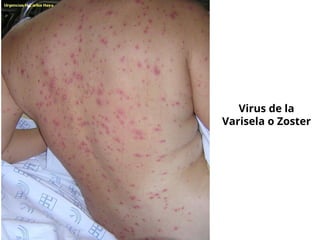 Virus de la
Varisela o Zoster
 