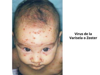 Virus de la
Varisela o Zoster
 