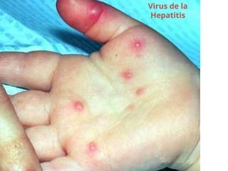 Virus de la
Hepatitis
 