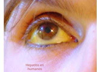 Hepatitis en
humanos
 