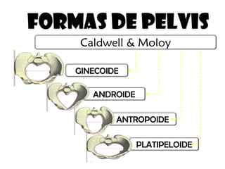 FORMAS DE PELVIS
GINECOIDE
ANDROIDE
ANTROPOIDE
PLATIPELOIDE
Caldwell & Moloy
 
