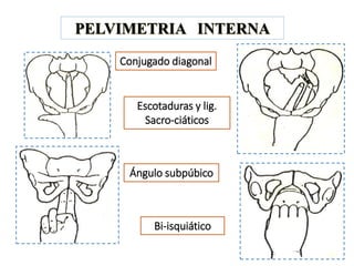 PELVIMETRIA INTERNA
Conjugado diagonal
Escotaduras y lig.
Sacro-ciáticos
Ángulo subpúbico
Bi-isquiático
 