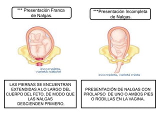 *** Presentación Franca
de Nalgas.
***Presentación Incompleta
de Nalgas.
LAS PIERNAS SE ENCUENTRAN
EXTENDIDAS A LO LARGO DEL
CUERPO DEL FETO, DE MODO QUE
LAS NALGAS
DESCIENDEN PRIMERO.
PRESENTACIÓN DE NALGAS CON
PROLAPSO DE UNO O AMBOS PIES
O RODILLAS EN LA VAGINA.
 