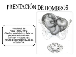 -Frecuencia de:
1/300-400 PARTOS.
-Significa que el eje long. Fetal es
perpendicular al Materno
(Situación TRANSVERSA)
-PUNTO DE REFERENCIA ES EL
ACROMIÓN.
 