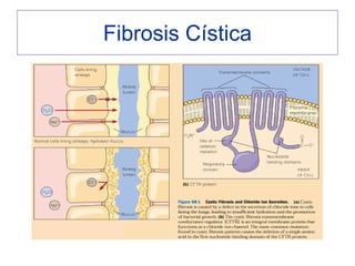 Fibrosis Cística
 