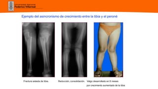 Universidad Nacional
Federico Villarreal
Ejemplo del asincronismo de crecimiento entre la tibia y el peroné
Fractura aislada de tibia. Reducción, consolidación. Valgo desarrollado en 6 meses
por crecimiento aumentado de la tibia
 