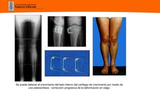 Universidad Nacional
Federico Villarreal
Se puede detener el crecimiento del lado interno del cartílago de crecimiento por medio de
una osteosíntesis : corrección progresiva de la deformación en valgo.
 