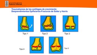 Universidad Nacional
Federico Villarreal
Traumatismos de los cartílagos de crecimiento
Desprendimientos Epifisiarios-Fracturas de Salter y Harris
Tipo 1 Tipo 2 Tipo 3
Tipo 4 Tipo 5
 